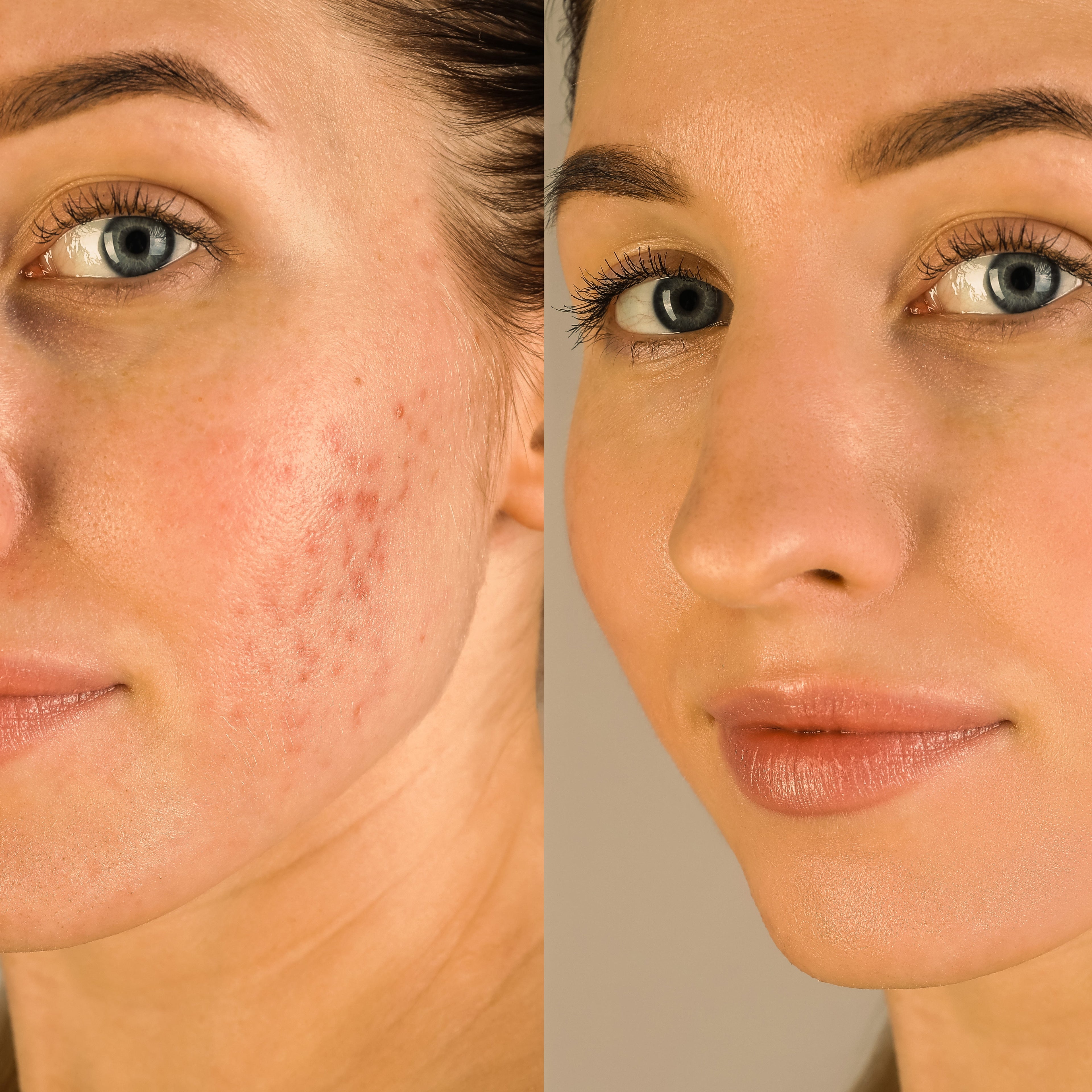 Acne Collection - Reduce Redness and Skin Inflammation