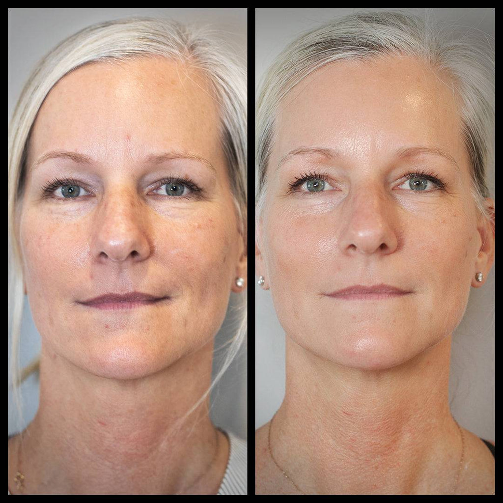 Before and after transformation using Aureterra Botanical Peptide Cream, showing softer wrinkles and more radiant skin.