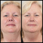 Before and after comparison of a woman's face with visible skin texture differences.