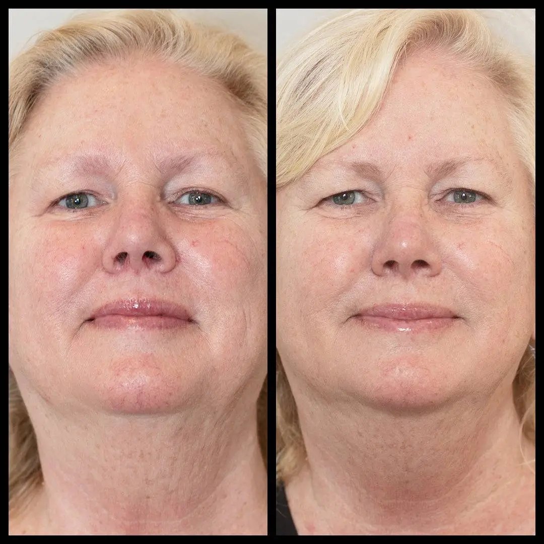 Before and after comparison of a woman's face with visible skin texture differences.
