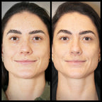 Before and after comparison of a woman's face with tighter skin and more youthful skin