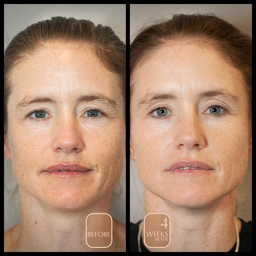 before and after four weeks woman mid forties from the glow starter kit Aureterra botanical peptide repair cream, anti aging facial polish, anti aging facial mist with vitamin C