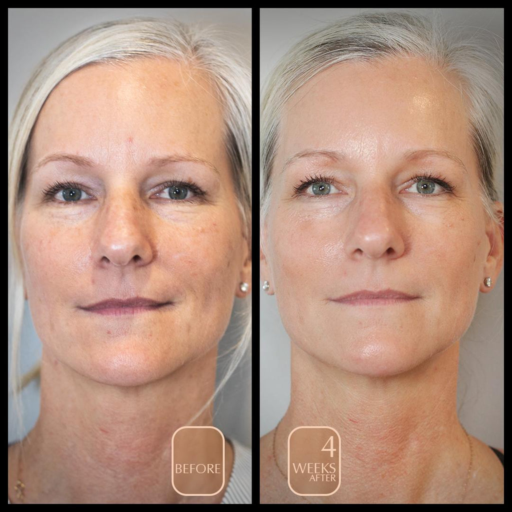 before and after mid to late 40s after 4 weeks of botanical peptide repair cream, anti aging facial polish, and anti aging facial mist with vitamin C