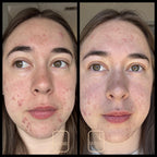 Acne Organic Face Cream with Rose Hydrosol