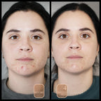 Before and after comparison of a person with acne on their face.