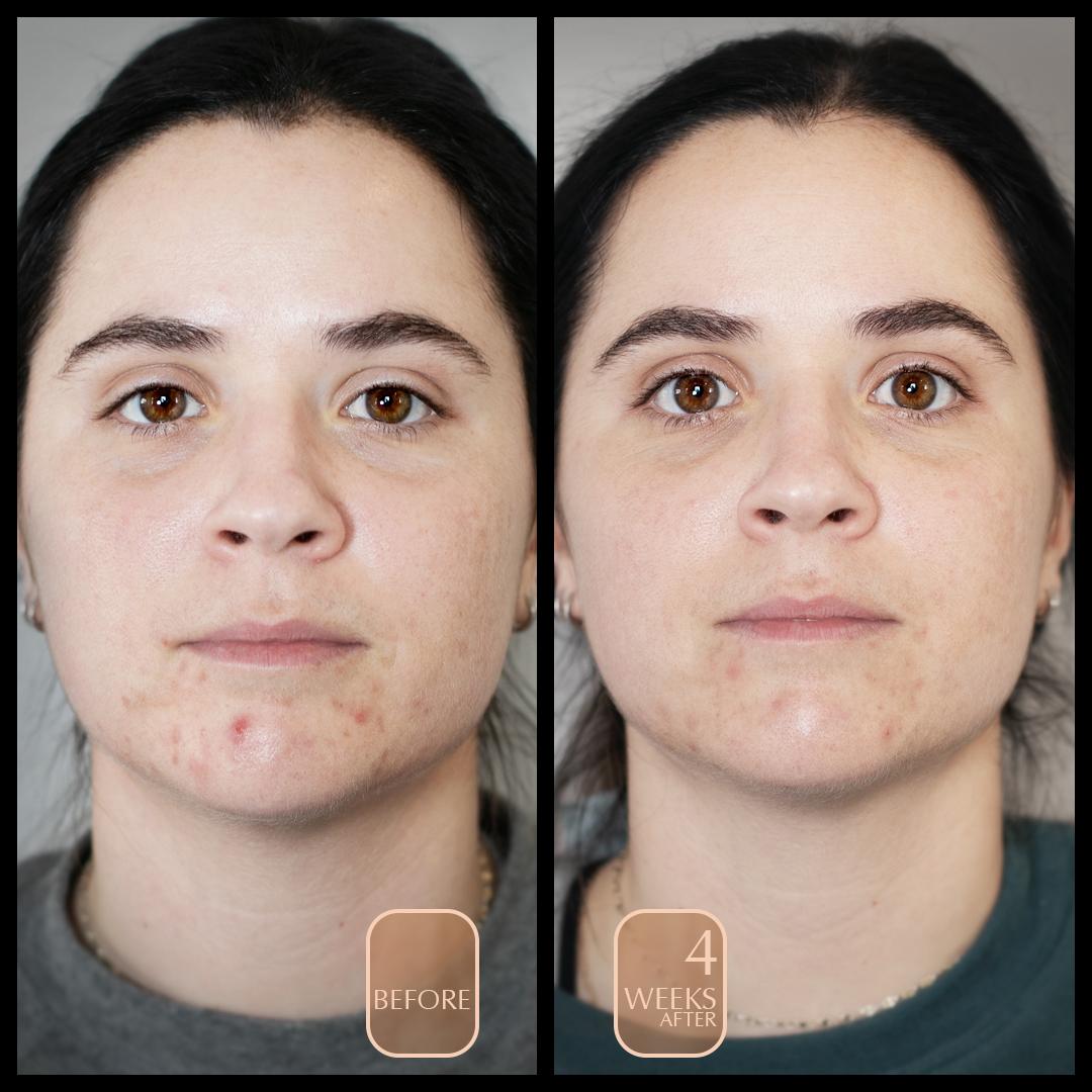 Before and after comparison of a person with acne on their face.