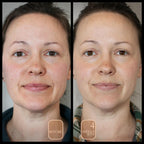 before and after with visible reduction in redness, reduced pore size, brighter tone and complexion, healthy glow
