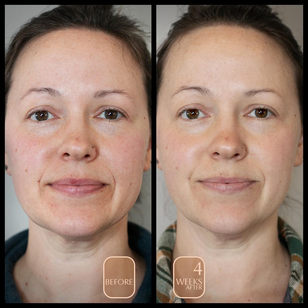 before and after with visible reduction in redness, reduced pore size, brighter tone and complexion, healthy glow